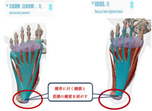 足底腱膜　短拇趾屈筋画像